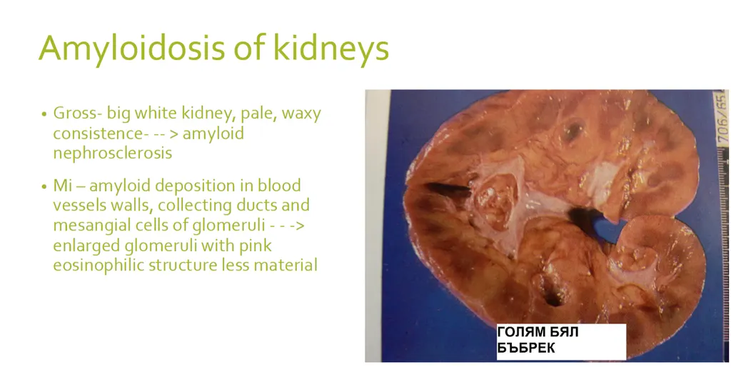 <p><strong><span>Mark the correct statement(s) for kidney amyloidosis</span></strong> </p><p>a) small, shrunken kidneys with granular surface and difficult decapsulation, </p><p><strong>b) enlarged pale kidneys with waxy texture, </strong></p><p>c) amyloidosis affects only one of the kidneys and doesn’t lead to chronic renal failure, </p><p>d) kidney amyloidosis is reversible after the treatment of the primary disease and has very good prognosis</p>