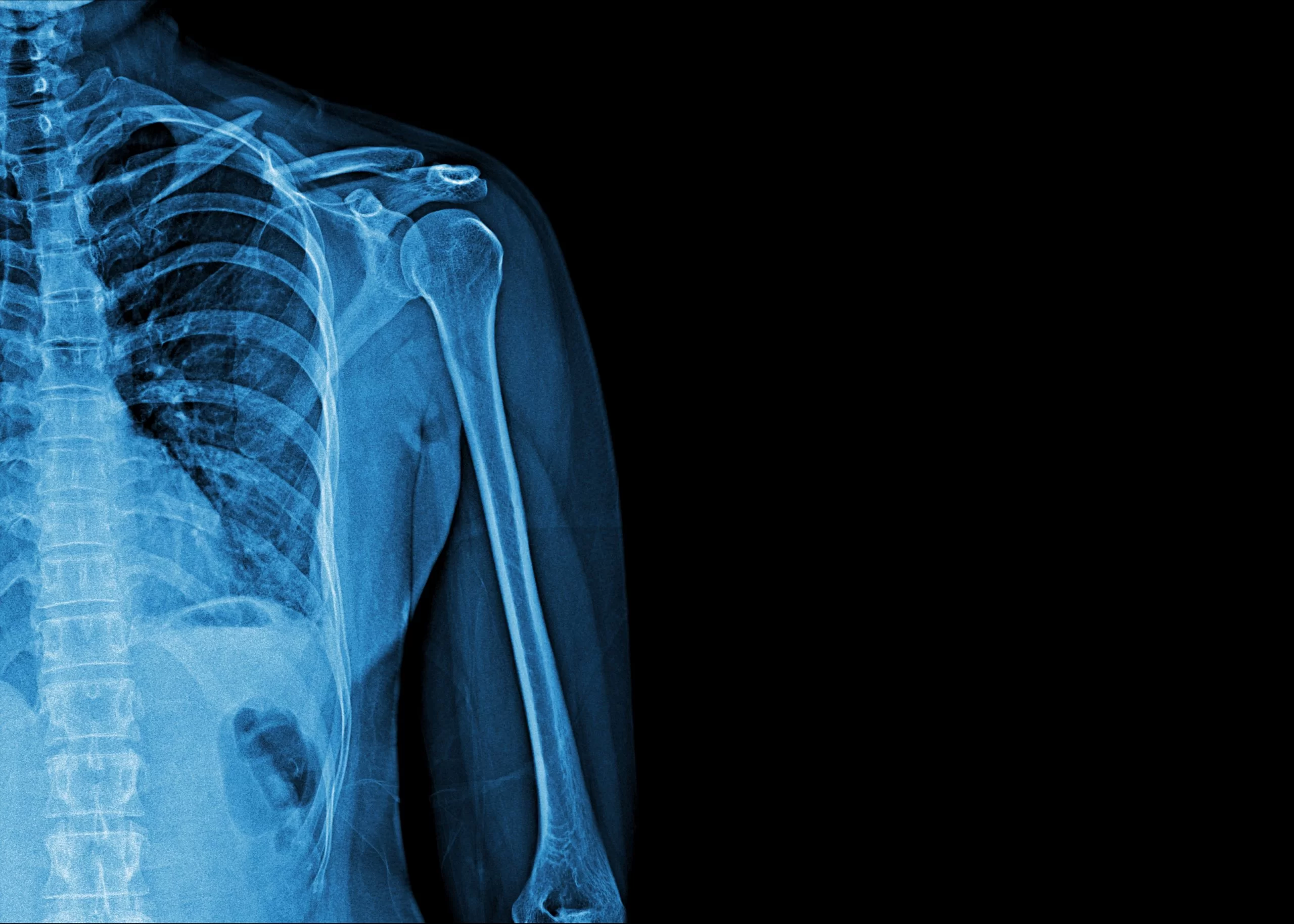 <p>X-rays - used to look at bones</p>