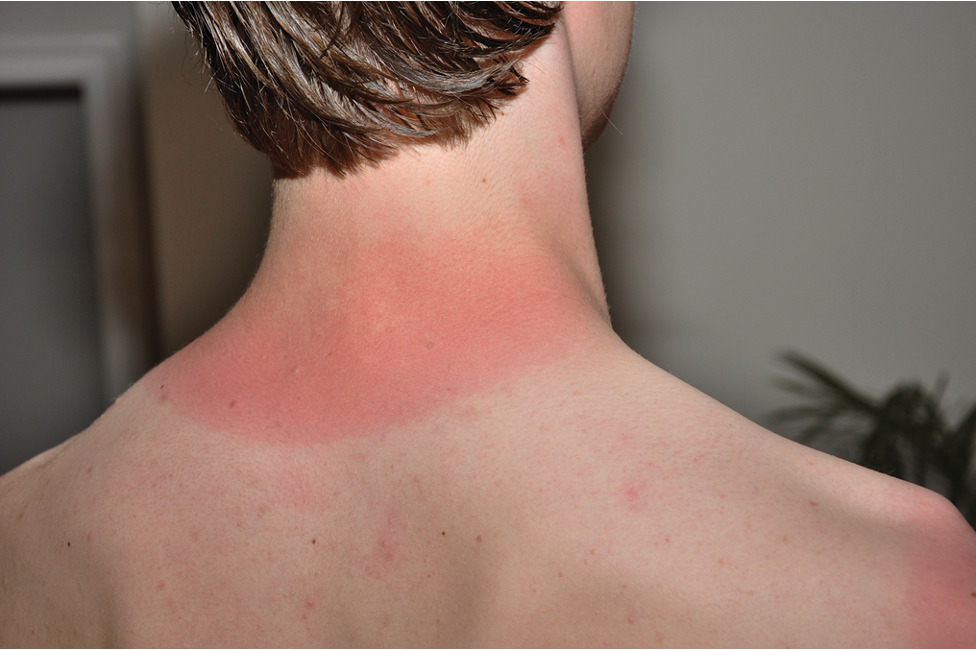 <ul><li><p><span>Involves only epidermis</span></p></li><li><p><span>Reddening with minor swelling</span></p></li></ul><p></p>