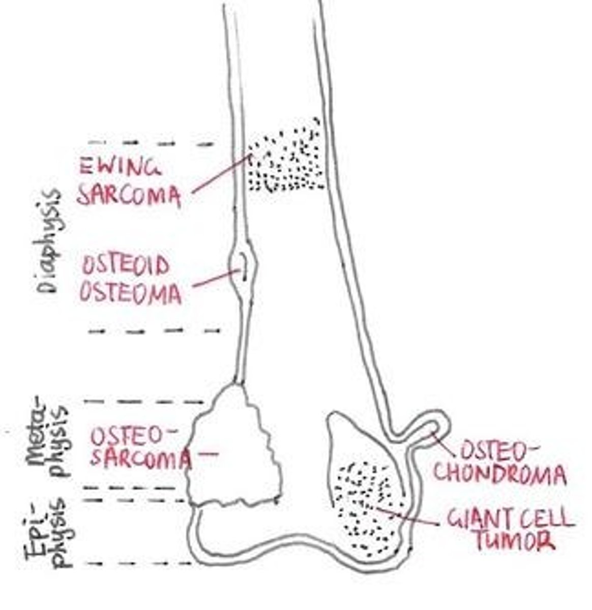 <p>An infection of the bone.</p>