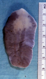 <p>deer liver fluke</p>