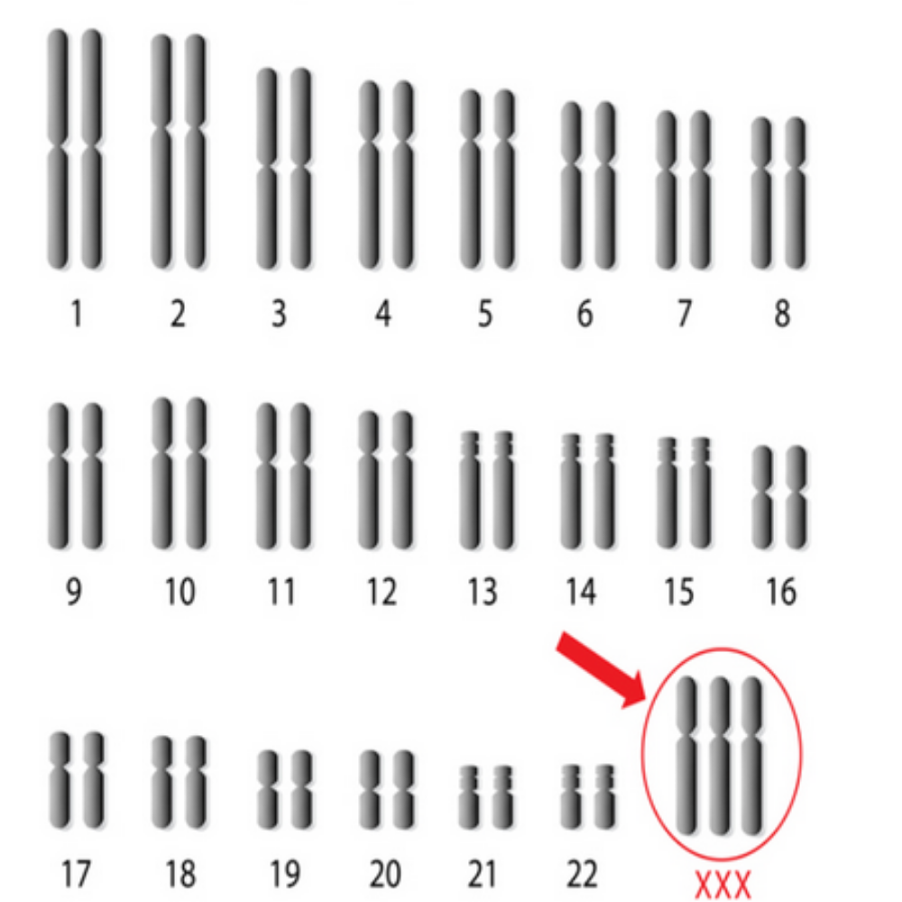 <p>Based on the set of chromosomes shown, what syndrome does this person have?</p>