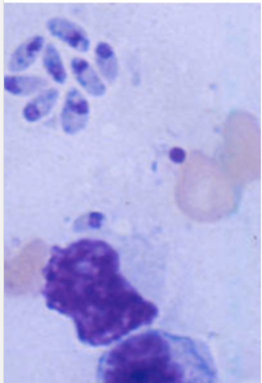 <p>What is seen in this image of lymph node aspirate?</p>
