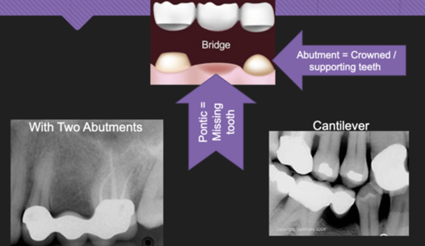 <p>- Pontic = Missing tooth</p><p>- Abutment = Crowned supporting teeth</p>