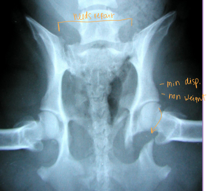 <ul><li><p><span style="background-color: transparent;"><strong><span>Considerations:</span></strong><span> Multi physes, normally breaks at multi sites </span></span></p><ul><li><p><span style="background-color: transparent;"><strong><span>Sciatic n.:</span></strong><span> through ischiatic notch</span></span></p></li><li><p><span style="background-color: transparent;"><strong><span>Weight transfer:</span></strong><span> </span></span><span style="background-color: transparent; color: red;"><span>paw → tibia → femur → acetabulum → ilium → SI joint</span></span></p></li></ul></li></ul><ul><li><p><span style="background-color: transparent;"><strong><span>Et: </span></strong><span>males > females, trama</span></span></p></li><li><p><span style="background-color: transparent;"><strong><span>Dt: </span><u><span>Rads, CT</span></u></strong><span> for complex fractures/Sx planning</span></span></p></li><li><p><span style="background-color: transparent;"><strong><span>Tx: </span></strong></span></p><ul><li><p><span style="background-color: transparent;"><strong><span>Rx:</span></strong><span> non-displaced, unilateral, non-articular, non-weight-bearing fractures</span></span></p><ul><li><p><span style="background-color: transparent;"><strong><u><span>6 w crate rest</span></u></strong><span>, sling, pain control, controlled walks, PT</span></span></p></li></ul></li><li><p><span style="background-color: transparent;"><strong><span>Sx: </span></strong><span>ilium/acetabulum/SI joint (weight-bearing), bilateral fractures, displacement, colon compromise, pelvic canal compromise (parturition), sciatic entrapment</span></span></p><ul><li><p><span style="background-color: transparent;"><strong><span>Ilium:</span></strong><span> plate + screws</span></span></p></li><li><p><span style="background-color: transparent;"><strong><span>Acetabulum:</span></strong><span> plate + screws, cross pins, PMMA</span></span></p></li><li><p><span style="background-color: transparent;"><strong><span>SI joint: </span></strong><span>screw stabilization</span></span></p></li></ul></li></ul></li></ul><img src="https://knowt-user-attachments.s3.amazonaws.com/15647344-9d74-4fd4-83b7-fc196a56d335.png" data-width="25%" data-align="center" alt="normal"><p></p>