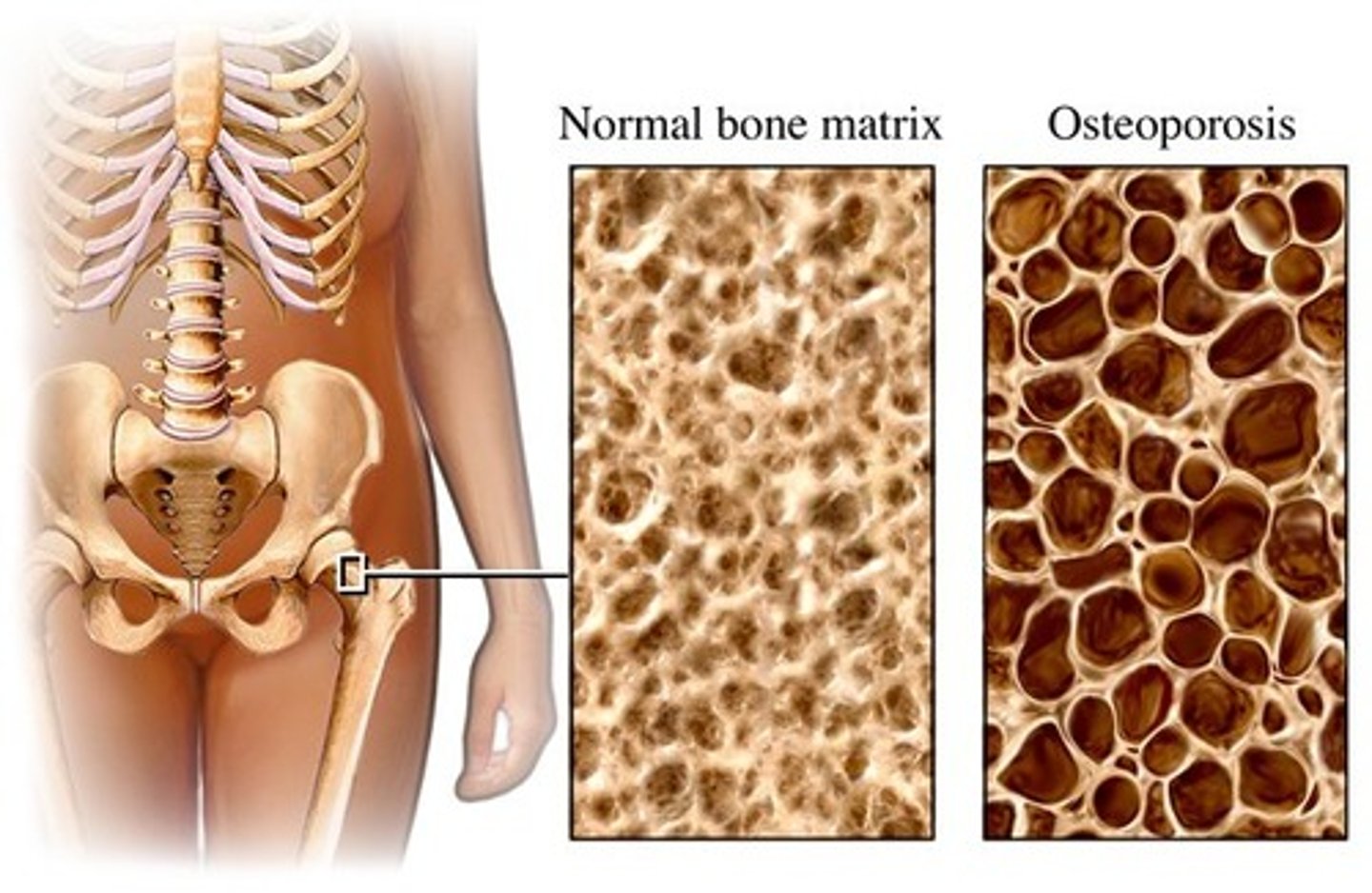 <p>A decrease in bone mass, usually due to decreased</p><p>levels of estrogen and testosterone</p><p>Causes fractures and shrinkage of the spine</p><p>Osteoblasts become less active</p><p>Can also be caused by a calcium deficiency</p><p>Alcohol can play a role as it is toxic to osteoblasts</p><p>Manifestations include kyphosis and brittle bones due to low bone density.</p>
