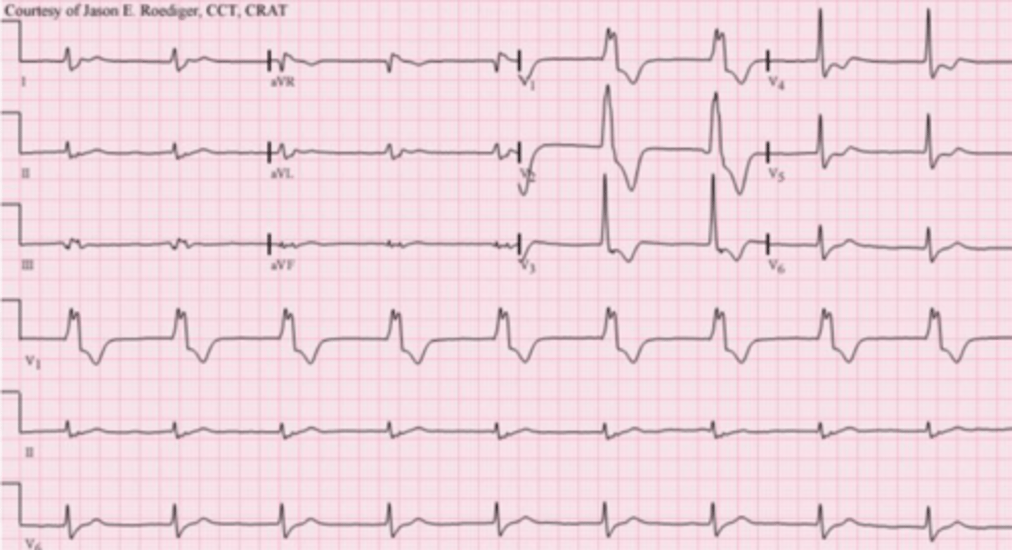 <p>What is an accelerated idioventricular rhythm</p>