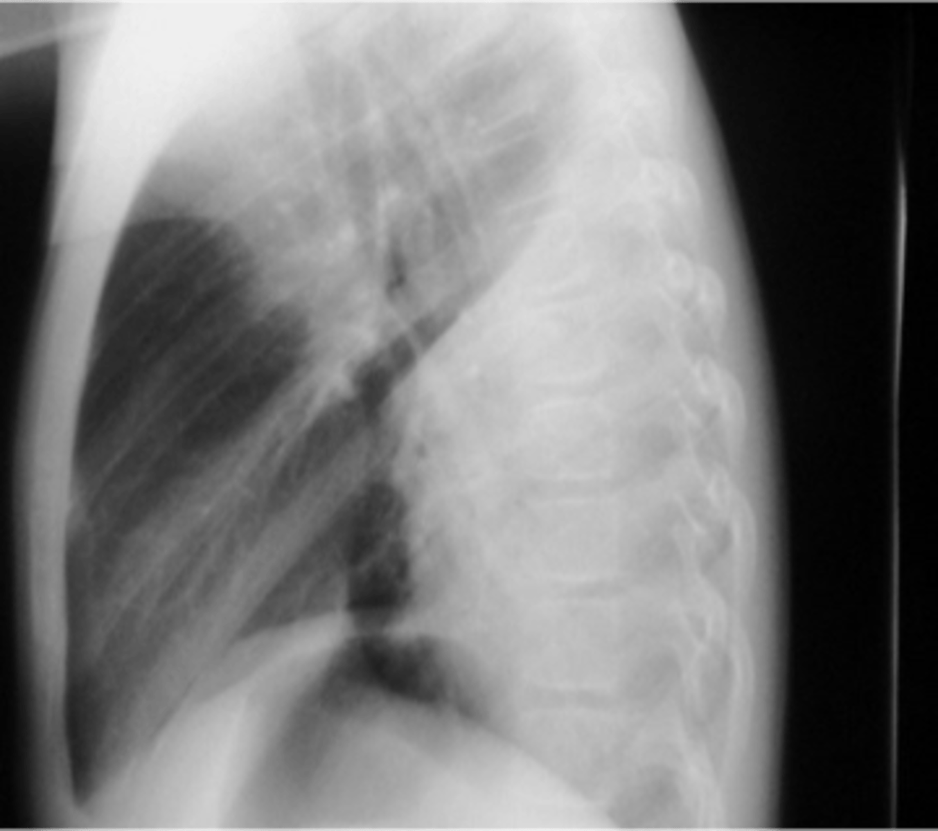 <p>spine sign</p>
