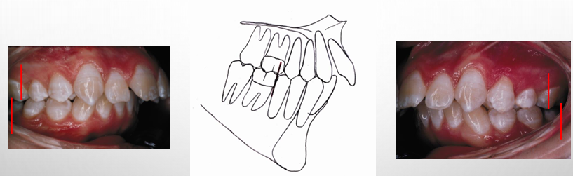 <p>-most common</p><p>-a malocclusion where the molar relationship shows the buccal groove of the mandibular first molar distally positioned when in occlusion with the mesiobuccal cusp of the maxillary first molar</p>