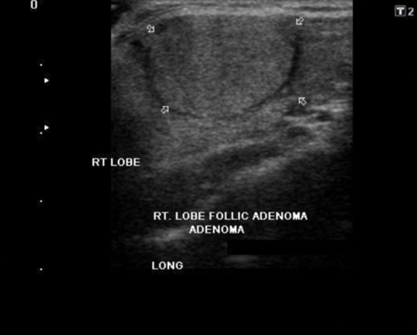 <p>Etiology</p><p>-Composed of epithelial tissue</p><p>-Most common thyroid neoplasm</p><p>Clinical findings</p><p>-Asymptomatic</p><p>-Hyperthyroidism</p><p>-Female prevalence (7:1)</p><p>Sonographic findings</p><p>-Homogeneous echogenic mass</p><p>-Prominent hypoechoic peripheral halo</p><p>-Peripheral blood flow</p><p>-May degenerate and appear complex</p><p>-"Cold" nodule on nuclear medicine scan </p>