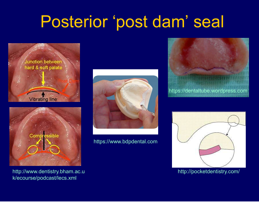 <p>The junction between the soft and hard palate or vibrating line</p><p>that area the tissues are quite compressible, </p><p>want seal all around the denture</p><p>back of denture provide a ridge of acrylic on the inside fitting surface that’s lightly digs in the mucosa - post dam</p><p>created by cutting a groove in the cast between the hamular notches resulting in a raised bit of acrylic to maintain the seal and stop air from getting into the back of the denture</p><p><strong>seal</strong> only applies to complete dentures as as soon as there is a natural tooth, air can get in around that tooth, teeth compromise the seal</p>