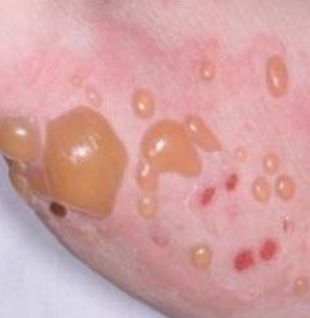 <p>vesicle, pustule, or bulla</p>