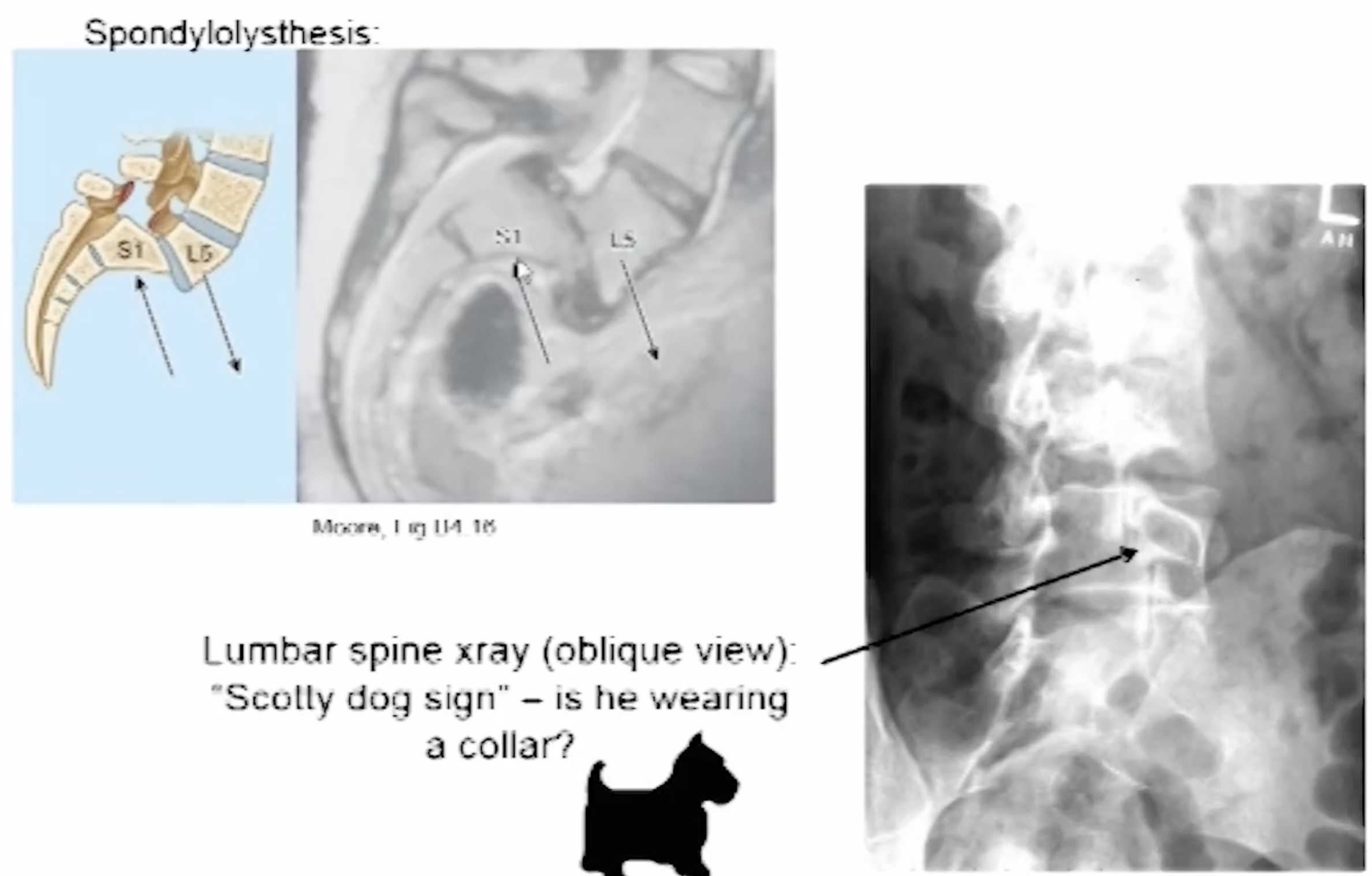 <p>Spondylolysthesis - forward slip of one vertebrae on another due to bilateral pars interarticularis fracture </p>