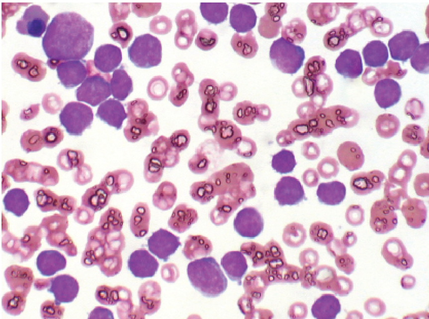 \-arise from embryonic mesodermal origin 

\-composed of spindle cells arranged in streams and bundles

\-bengin tumors use suffix -oma

\-malignant tumors use sarcoma 