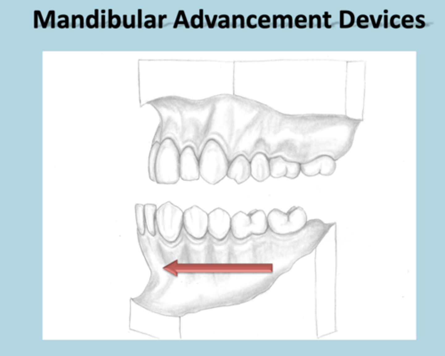 <p>Protrude jaw forward and precipitate bite changes</p>