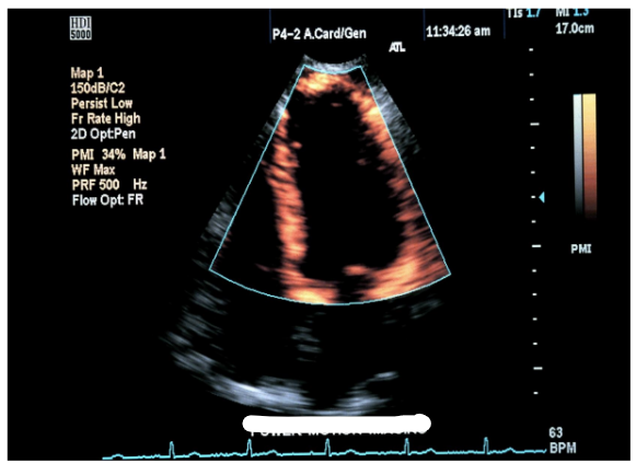 <p>improves evaluation of the cardiac wall</p>