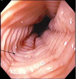 <p><strong>Eosinophilic Esophagitis: Diagnosis and Treatment</strong></p><p>-Diagnosis → EGD with _____ makes the diagnosis</p><ul><li><p>______ appearance ('“feline” esophagus), strictures, attenuation of subepithelial vascular pattern, _____ furrows, whitish papules </p></li><li><p>Biopsy shows increased number of ____________</p></li></ul><p>-Treatment → start with ________ therapy and avoiding known allergens </p><ul><li><p>Pharmacologic therapy if dietary fails → PPI or topical _____________ (Fluticasone)</p></li><li><p>Esophageal dilation</p></li></ul><p></p>
