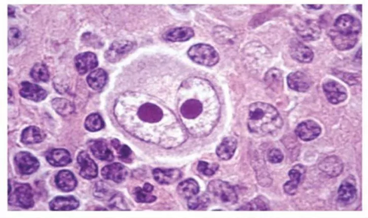 <p>To su zapravo limfociti B koji izbjegavaju apoptozu</p><p>Imaju bazofilnu citoplazmu, 2 segmenta jezgre, grub kromatin i izgledaju poput sovinih očiju </p>