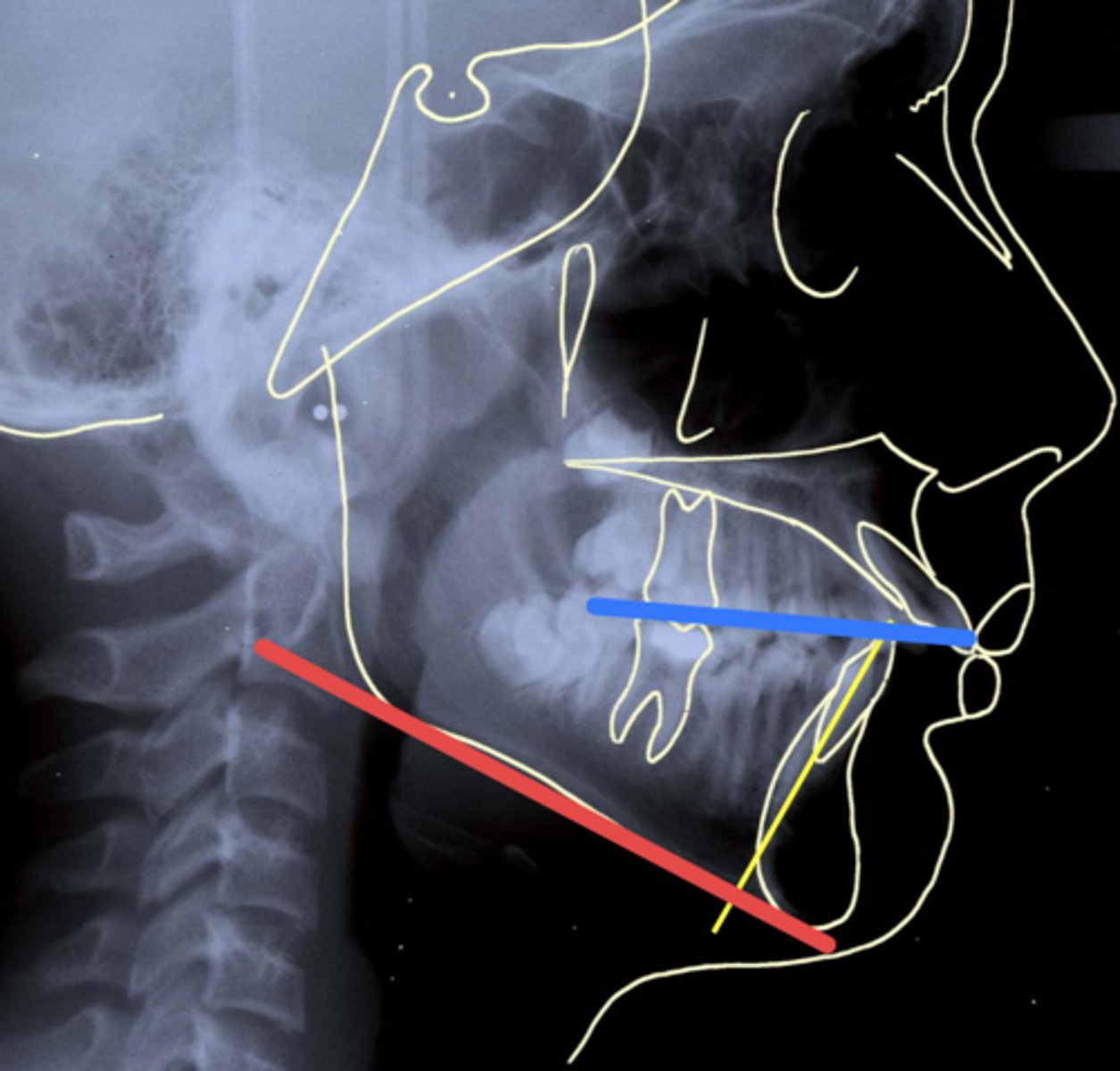 <p>ID the measurement being taken with the blue and yellow line:</p>