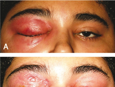 <p>infection of anterior portion of eyelid</p>