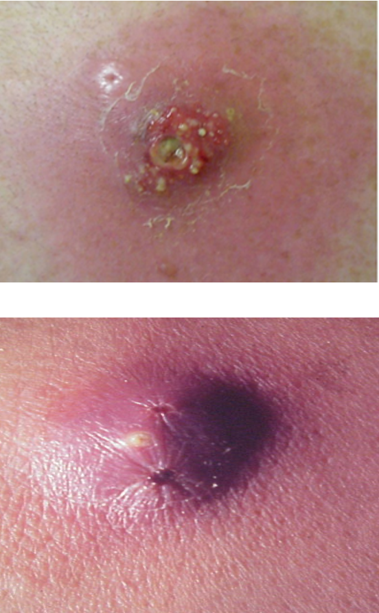 <p>deep (epidermis, dermis, SC) infection of hair follicle or sebaceous gland; progresses into abscess or pustule</p>