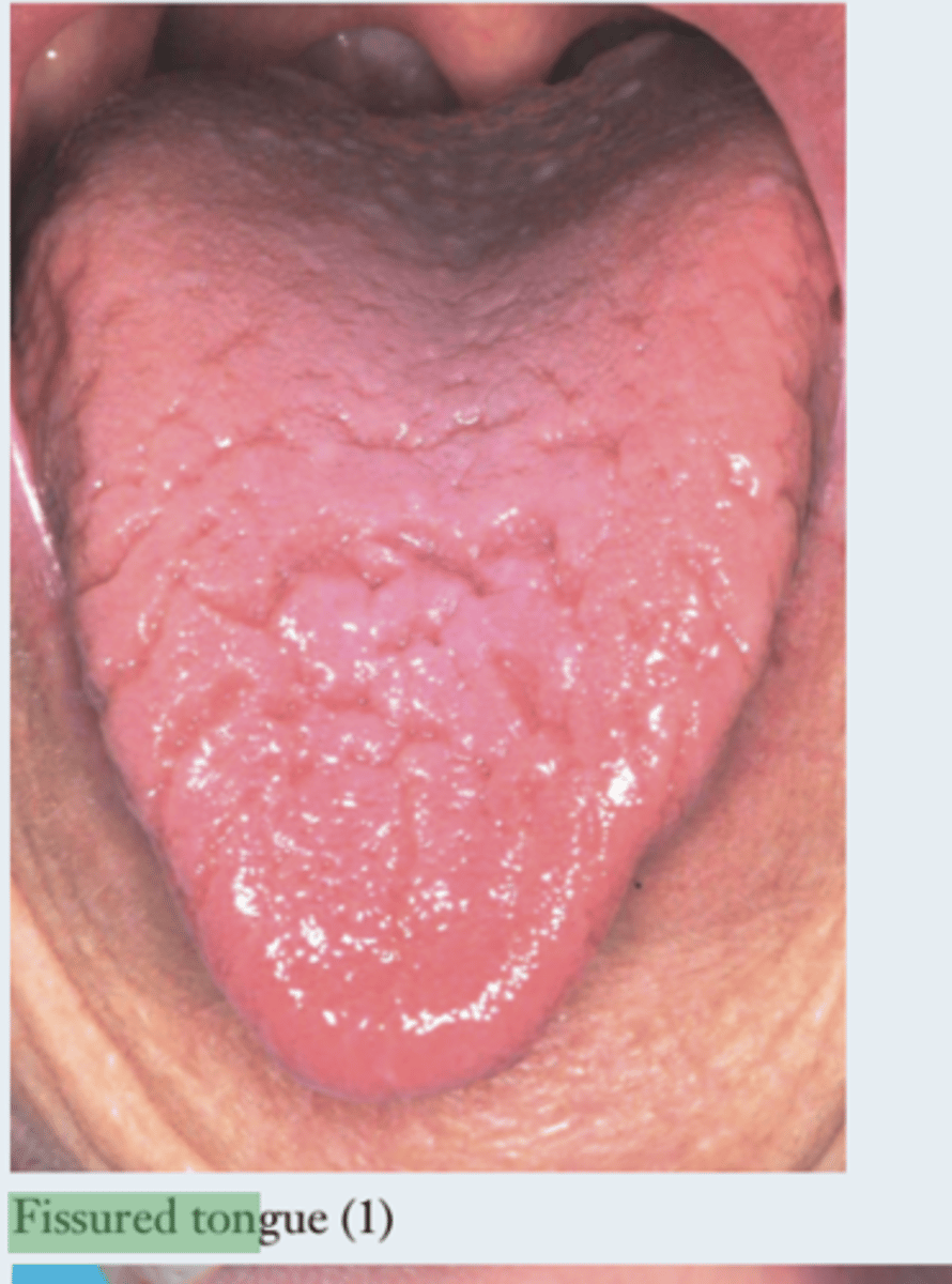 <p>deep grooves present on the dorsum on the tongue</p>