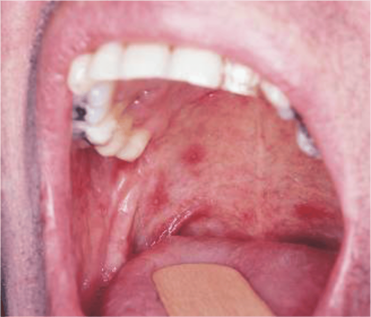 <p>herpetiform aphthous ulcers</p>