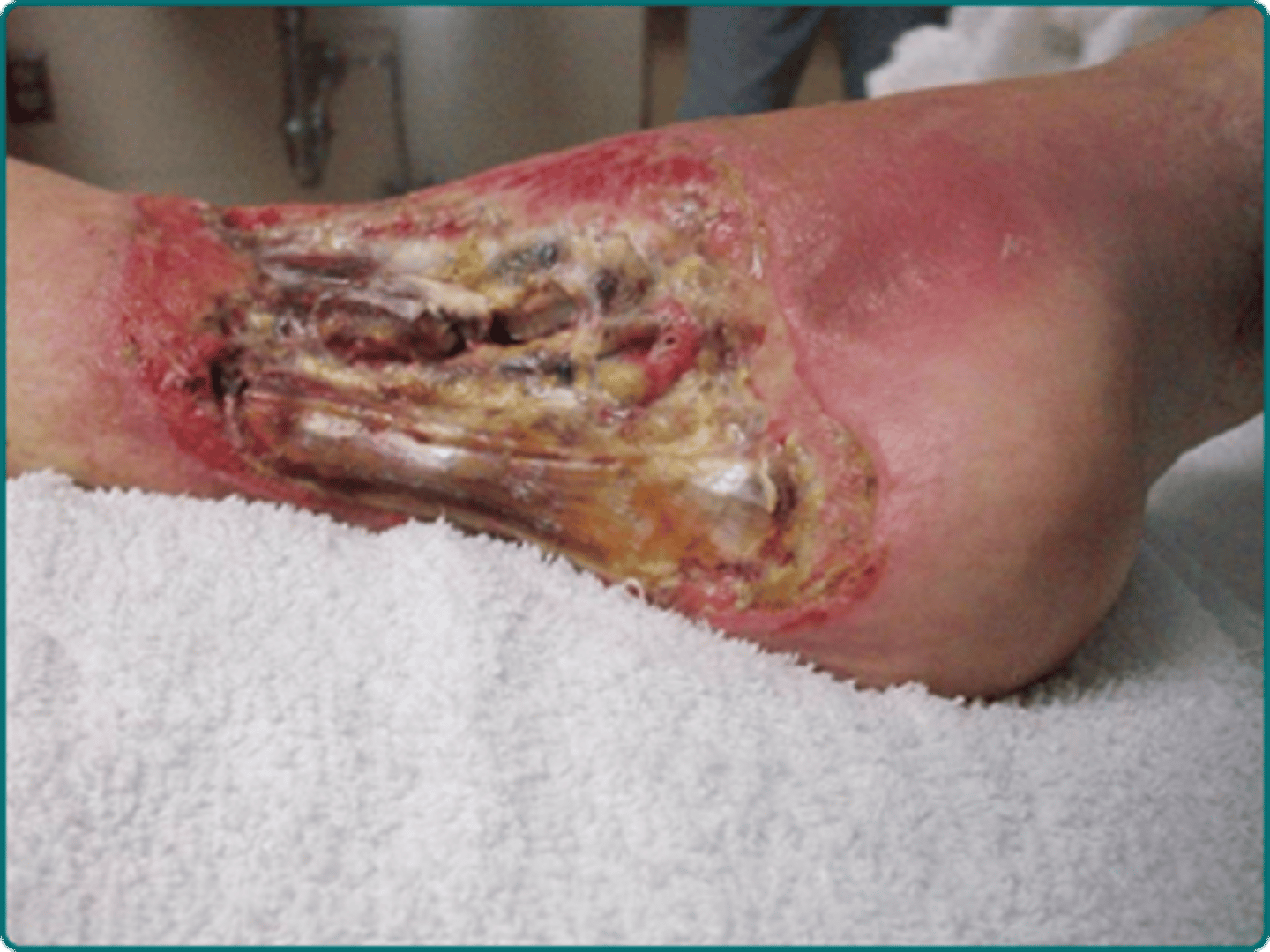 <p>- involves all layers of the skin + underlying structures involved => muscle, bone, joints</p>