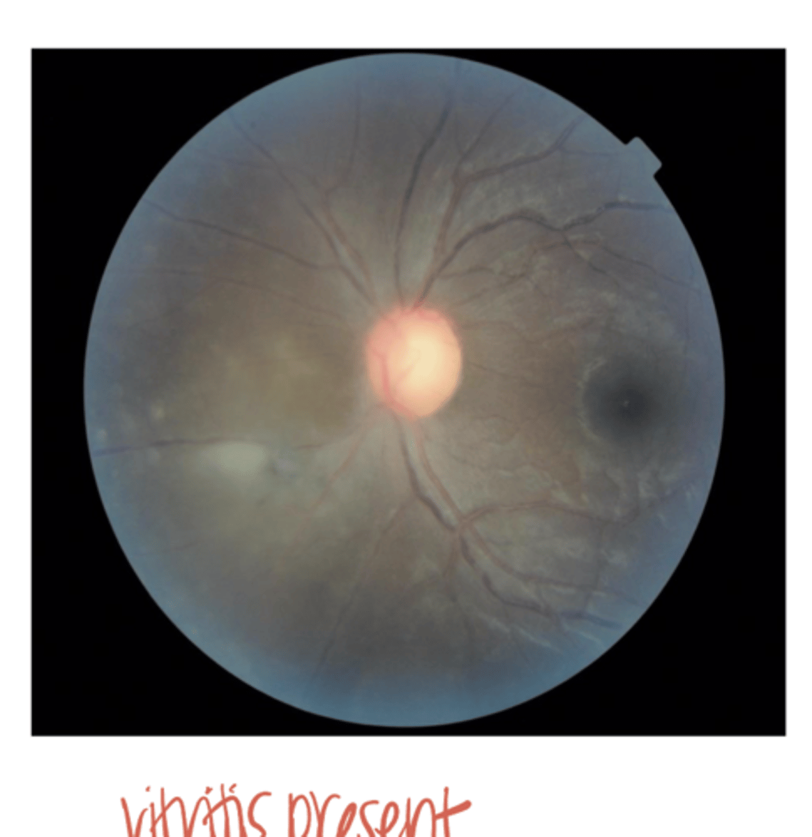 <p>Toxoplasmosis -- Active (Pic)</p>