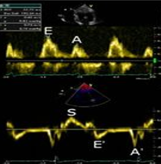 <p><span style="font-family: "Century Gothic";">A patient's pulsed wave Doppler of the mitral valve had an E/A ratio of 1.5. The patients tissue Doppler had a decreased e' velocity and E/e' ratio >14. What is the most likely diagnosis?</span></p>