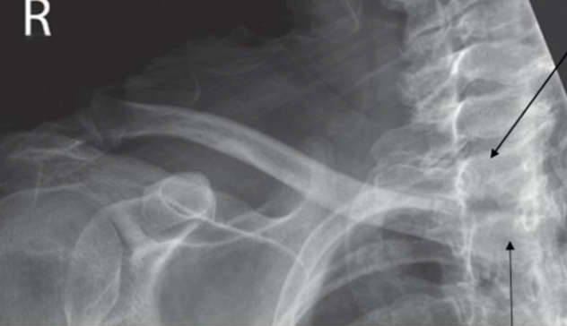 <p>how do you fix this AP clavicle</p>