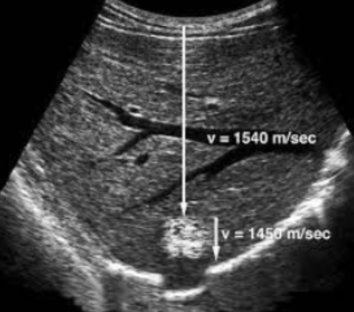 <ul><li><p><span style="background-color: transparent;">Caused by a structure of lower or higher velocity than 1540 m/s (what the machine assumes)</span></p></li><li><p><span style="background-color: transparent;">Appears as:</span></p><ul><li><p><span style="background-color: transparent;">Vertical displacement behind area of non-1540 m/s</span></p></li><li><p><span style="background-color: transparent;">Faster = shallower</span></p></li><li><p><span style="background-color: transparent;">Slower = deeper</span></p></li><li><p><span style="background-color: transparent;">Distortion of shape of the object</span></p></li></ul></li></ul><ul><li><p><span style="background-color: transparent;">Cannot be eliminated</span></p></li><li><p><span style="background-color: transparent;">The image shows a hemangioma that causes a slower velocity and therefore makes a part of the diaphragm appear deeper than it really is</span></p></li></ul><p></p>