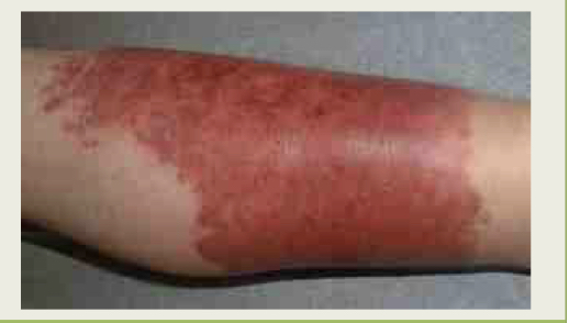 What infections is this?