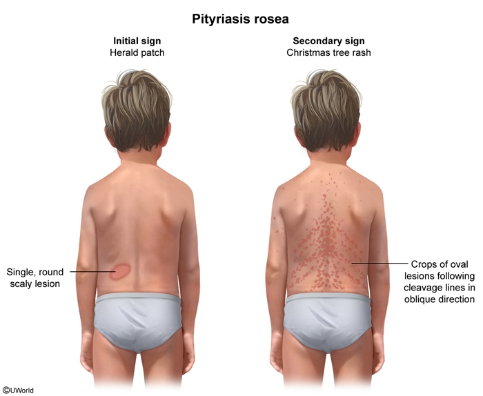 <p>pityriasis rosea</p>