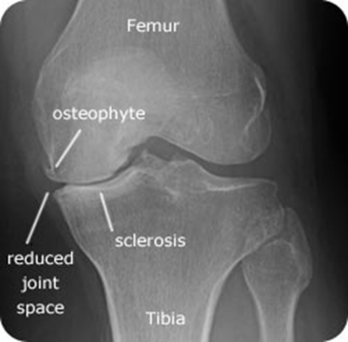 <p>weight-bearing AP films → shows narrowing of the joint space, bone sclerosis, periarticular (Baker's cyst) and osteophytes</p><p>XR is most important for diagnosis!</p>