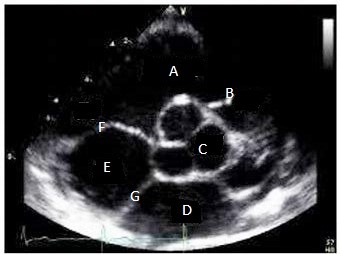 <p>Match anatomy in the SAX BASE view.</p>