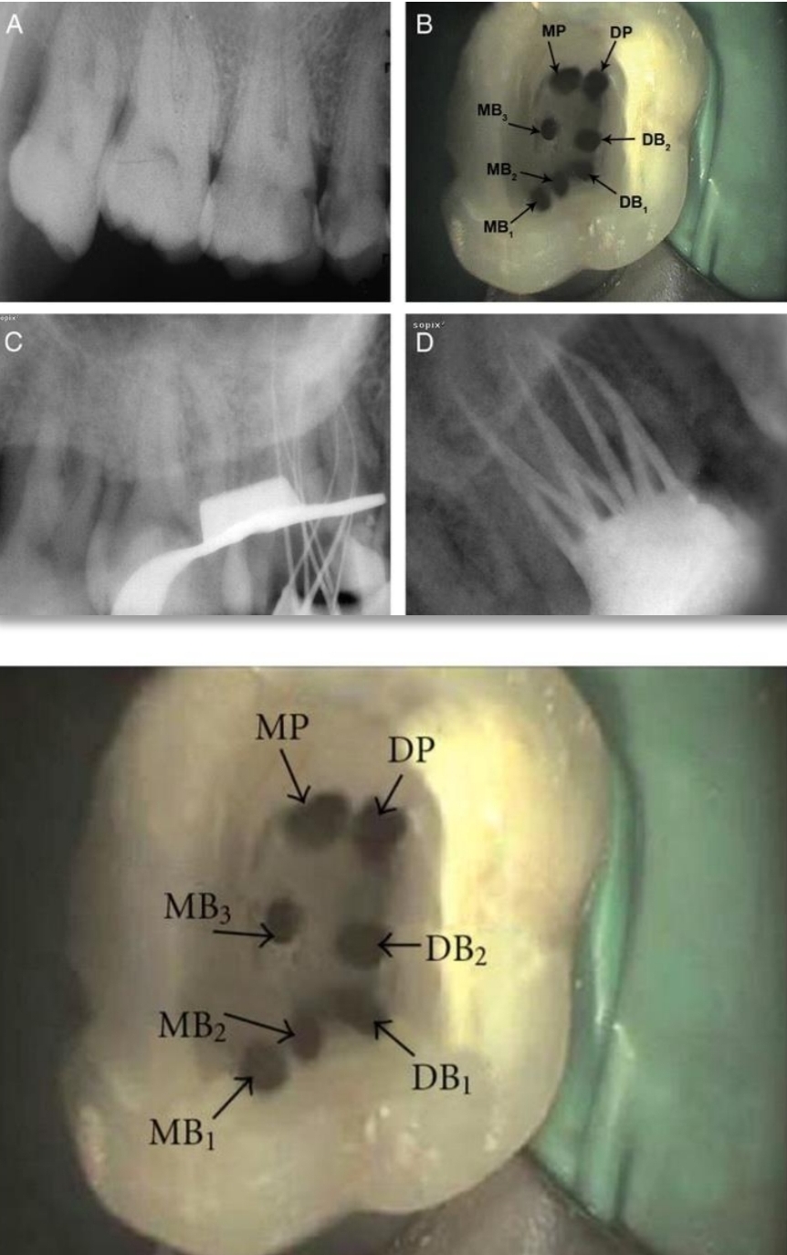 <p>Single root and canal</p><p class="has-focus">2 distal canals</p><p class="has-focus">2 palatal roots</p><p class="has-focus">3 MB caals</p><p class="has-focus">8 canals</p>