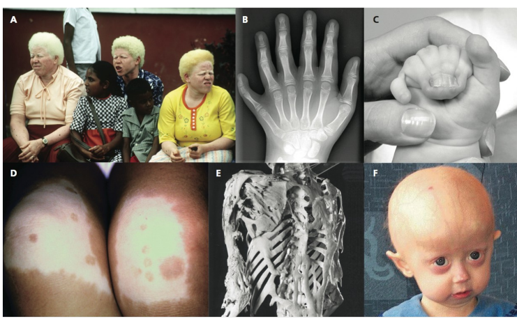 <p>albino-ism, extra digits, fused digits, hyper-/hypo- pigmentations, misshaped skeleton, large brain</p>