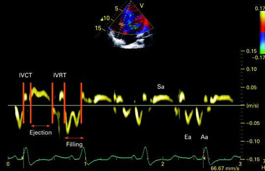 <p>place sample box anywhere on myocardium</p><p>shows phases of cardiac cycle &amp; tissue V</p><p><u>E:</u> LV rapid filling</p><p><u>A:</u> “atrial kick” late filling</p><p><u>E’ or A’ (prime):</u> mirror image of LV inflow</p>