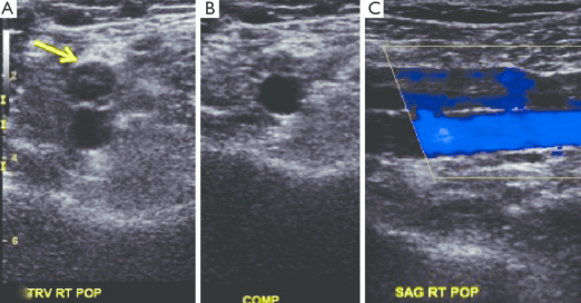 <p>Identify the following statements that describe this image obtain in patient with c/o periodic swelling RLE x 6 months with HX of DVT x 6 months ago post RT knee surgery. </p>