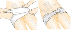 <p>These fractures can result in massive blood loss into the pelvic cavity, which may not be immediately obvious. Using a pelvic binder can slow the internal bleeding.</p>