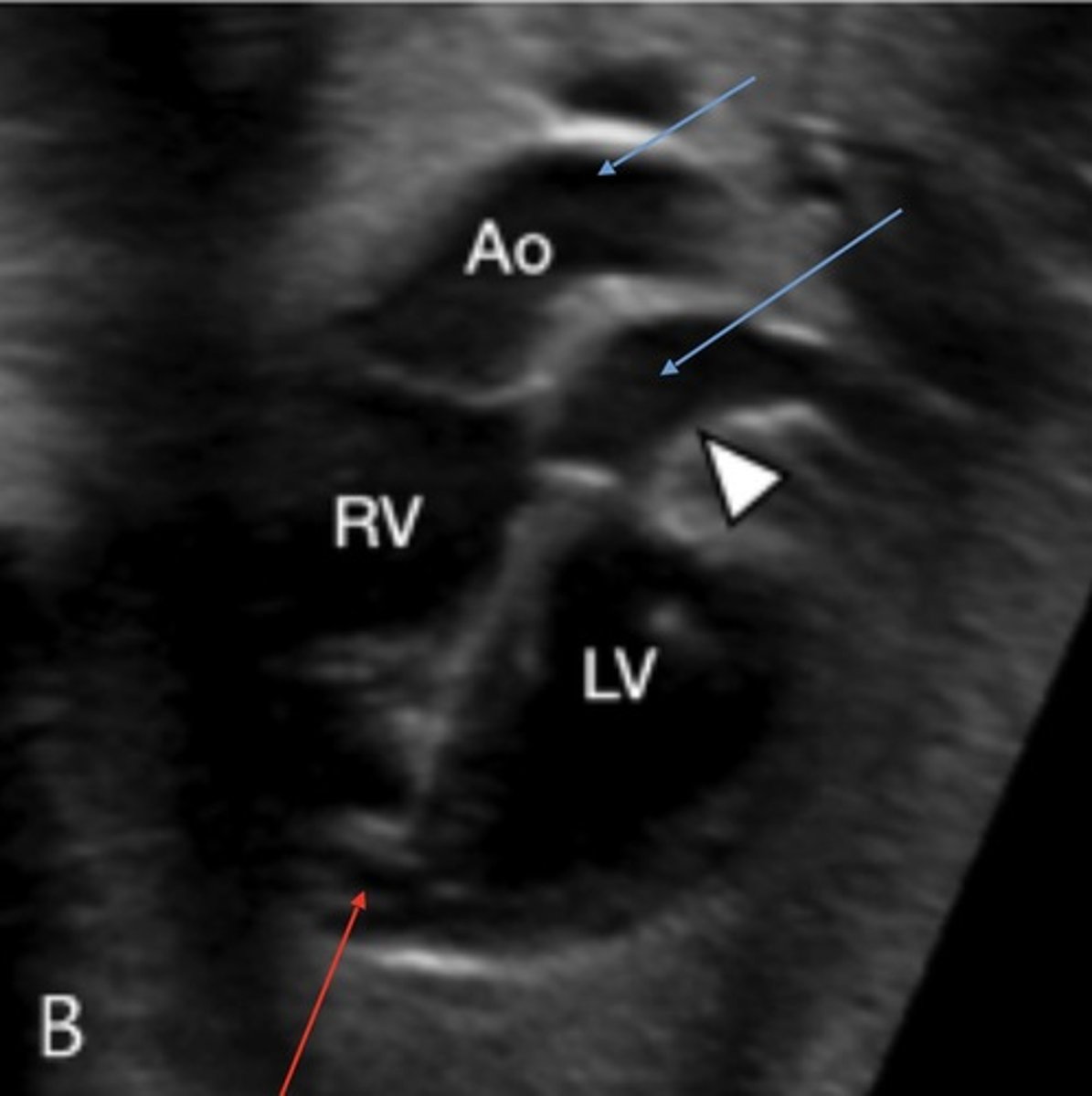 <p>Best seen in PSAX or LVOT view</p><p>Pulmonary A and AO originate from RV</p>