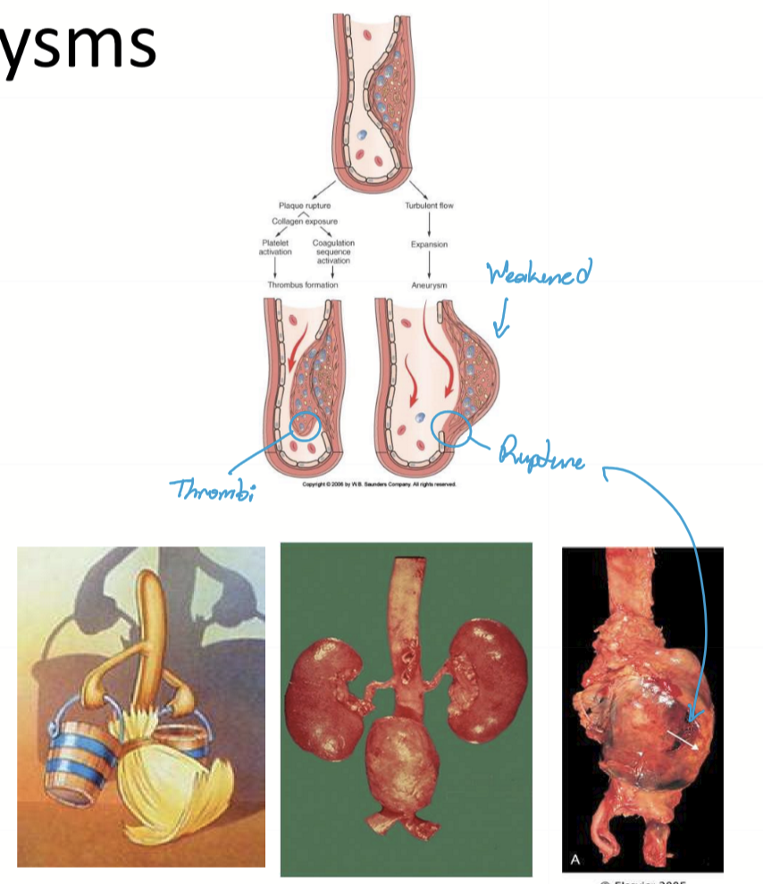 <ol><li><p>Atheroma forms in abdominal aorta, weakening the vessel wall</p></li><li><p>HTN causes dilation, and fusiform aneurysm forms </p></li><li><p>Sequelae: </p><ol><li><p>atheroma ruptures, causing thrombus and/or embolus</p></li><li><p>Vessel wall can rupture into retroperitoneum with a 90% morality rate </p></li></ol></li></ol><p></p>