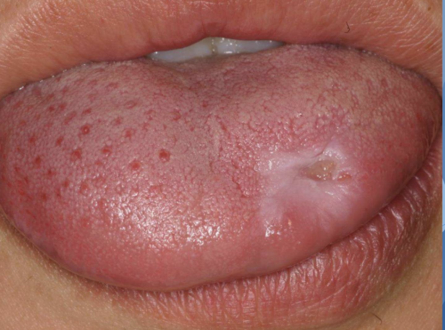 <p>Patient reportedly bites their tongue in the same spot a few times per week. What do you suspect?</p>