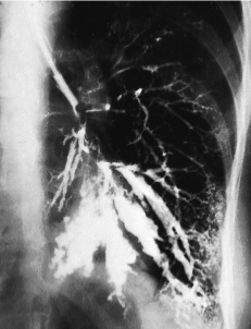 <p>Bronchiectasis </p>