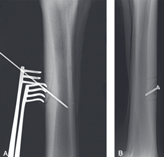 <ul><li><p><span>4-6 cm incision made over the fracture site</span></p><ul><li><p><span>In typical dorsolateral fracture, incision between the common digital and lateral digital extensor tendons</span></p></li></ul></li><li><p><span>Periosteum elevated and self-retaining retractors placed to expose the bone surface</span></p></li><li><p><span>Position screw within dorsal cortex placed</span></p><ul><li><p><span>In the middiaphysis of MCIII, bending occurs, therefore insertion of a screw engaging both cortices is not recommended</span></p></li></ul></li><li><p><span>Oblique drill hole made into medullary cavity in estimated correct location and confirmed with radiograph</span></p><ul><li><p><span>If hole is correctly positioned it can be used for the screw</span></p></li><li><p><span>If the hole is too proximal or distal an adjustment is made and the first hole just serves as another osteostixis hole</span></p></li></ul></li><li><p><span>Screw should not be countersunk as it will be removed in 60-80 days</span></p></li><li><p><span>Because it is not countersunk, the screw should not be excessively tightened or it will bend</span></p></li><li><p><span>Easiest error to make is not tapping completely through the distal cortex which will result in a 3.5 mm screw easily breaking during tightening</span></p></li><li><p><span>Most dorsal cortices accommodate a 22 mm screw</span></p></li><li><p><span>Approximately 6 2.5 mm holes are prepared through the dorsal cortex around the screw</span></p><ul><li><p><span>All holes must be drilled toward the medullary cavity and separated at least 10 mm</span></p></li></ul></li></ul>