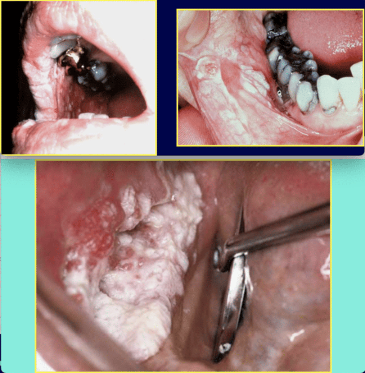 <p>• extensive, multiple white corrugated plaques </p><p>• NOT associated with risk factors -- 70% malignant change</p><p>• must biopsy</p><p>• Population: females over 50</p>