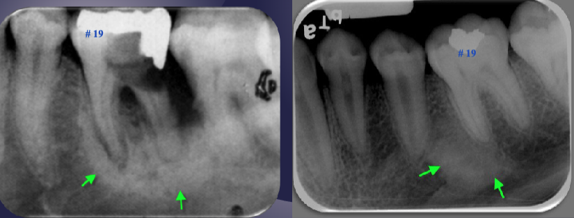 <p>differentiate the pathology of the 2 images </p>