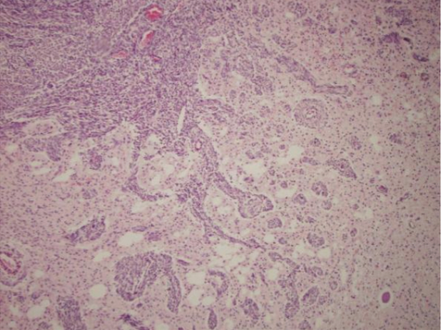<p><span style="background-color: transparent;">Examine the histological slide of this neoplastic lesion. </span></p><p><span style="background-color: transparent;">Which feature is most indicative that the tumor has metastatic potential?</span></p>
