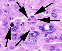 <p><strong>Councilman bodies</strong> (apoptotic acidophilic inclusions) in the liver.</p>